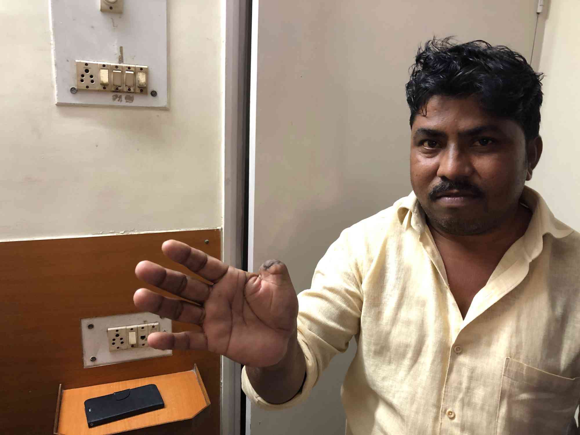 Sanitation worker Sanjay Pandharina Gote lost his thumb in the hydraulic cylinder of a garbage truck. (Photo credit: Sujatha Fernandes).