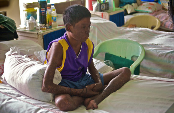 Leprosy Increases as World Gives Attention to Newer Endemic Diseases
